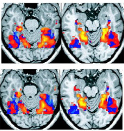 fMRI brain scan