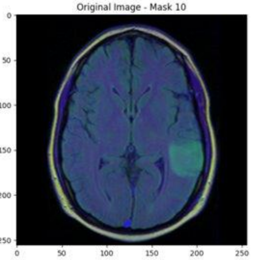 MRI scan showing brain tumour  (Image by Hana Chockler - used with permission)