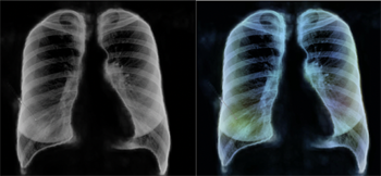 chest X-ray width=