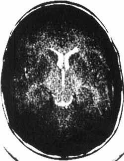 brain scan