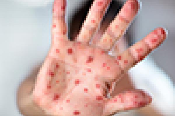 measles rash